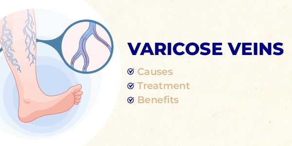 Varicose Veins